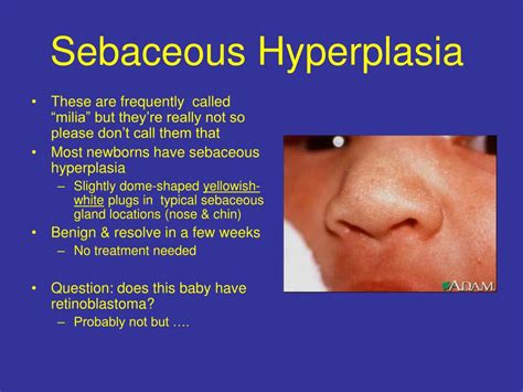 milia vs sebaceous hyperplasia